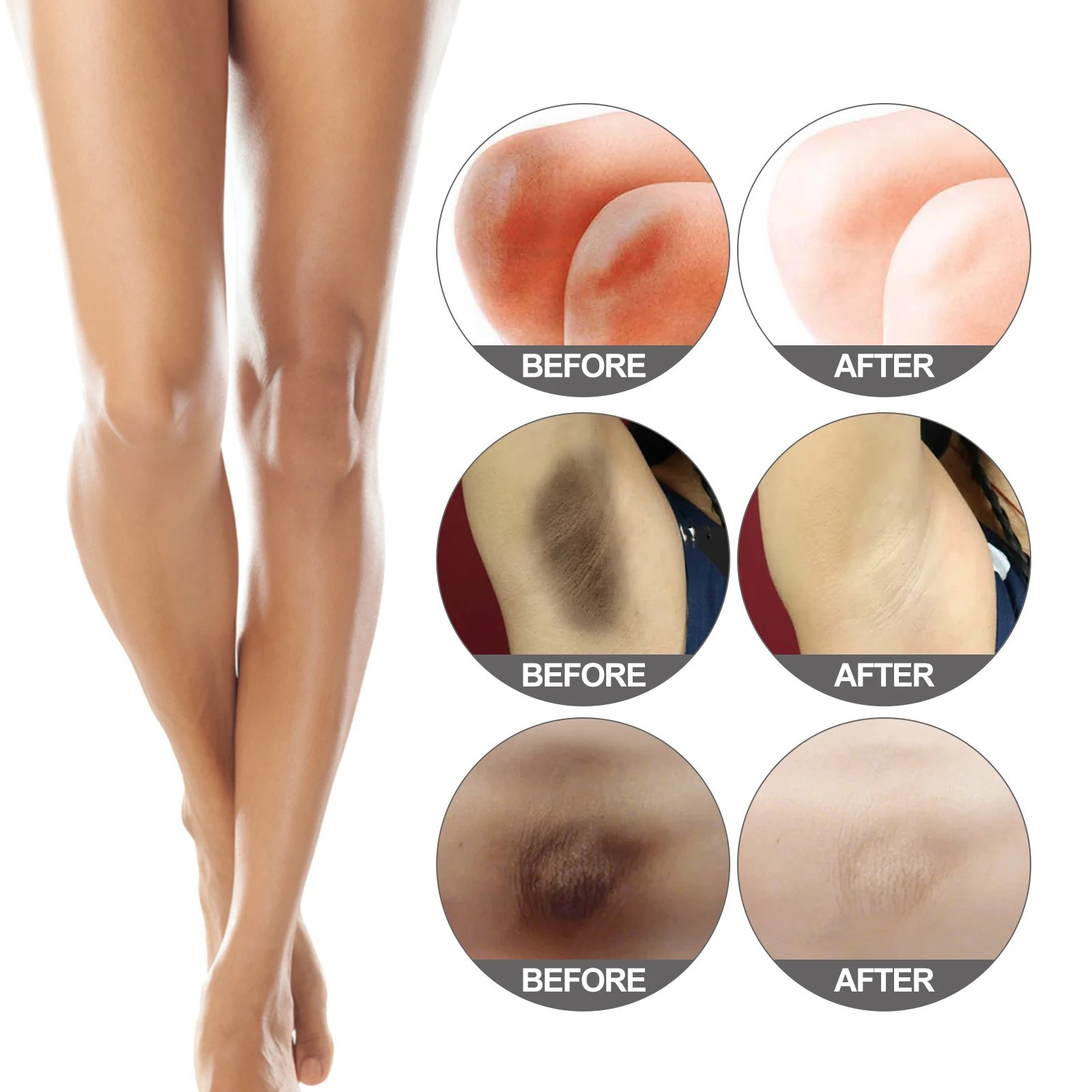 Whitening Cream Private Parts Underarm Bleaching Butt Knee Brighten Inner Thigh Intimate Parts Dark Remove Melanin Fine Skin